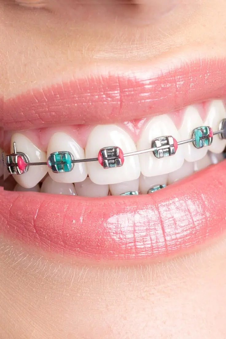 Braces with coloured elastics