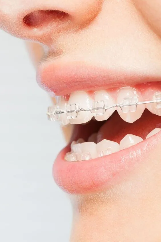 Aligned teeth
