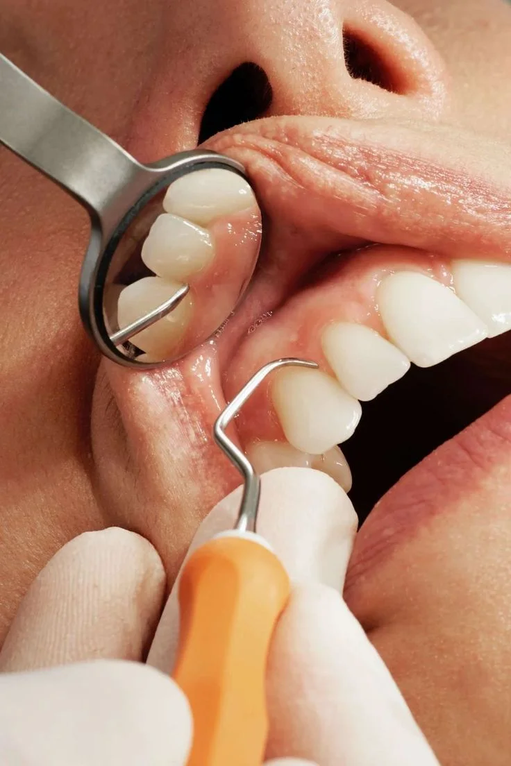 Control stomatologic cu oglinda dentară